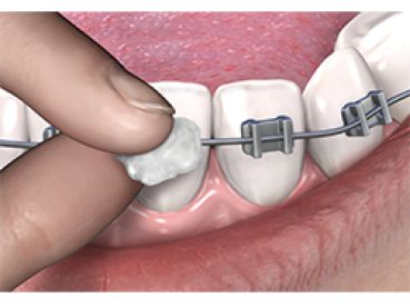 Cera ortodontica - singolo imballato - Negozio Ortho Depot per  ortodontisti, dentisti e cliniche