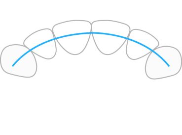 ProTain™ retainer digitale, mascella superiore