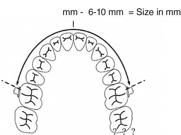 Arco di distalizzazione molare, misura 1 (80 mm)