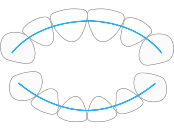 ProTain™ retainer digitale, mascella superiore & inferiore