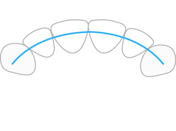 ProTain™ retainer digitale, mascella superiore