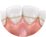 Perfetto adattamento del retainer grazie alla pianificazione 3D